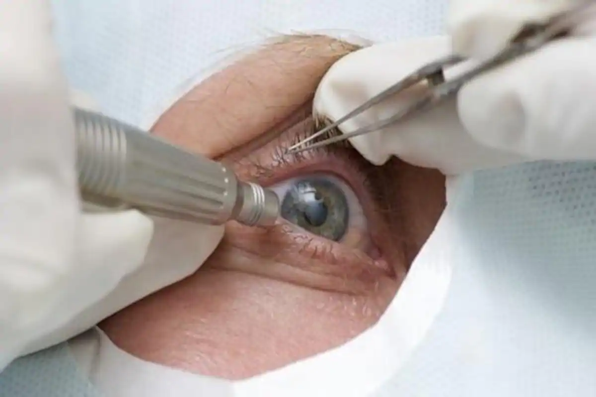 SA’s Cataract Surgery Under Pressure – 290 000 Could Lose Their Eye-Sight